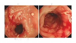 Шкала эндоскопической активности послеоперационного рецидива болезни Крона по Rutgeerts 